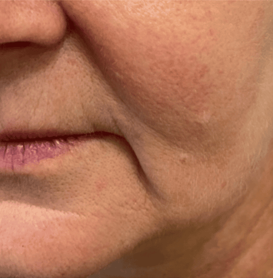 Face before HIFU treatment