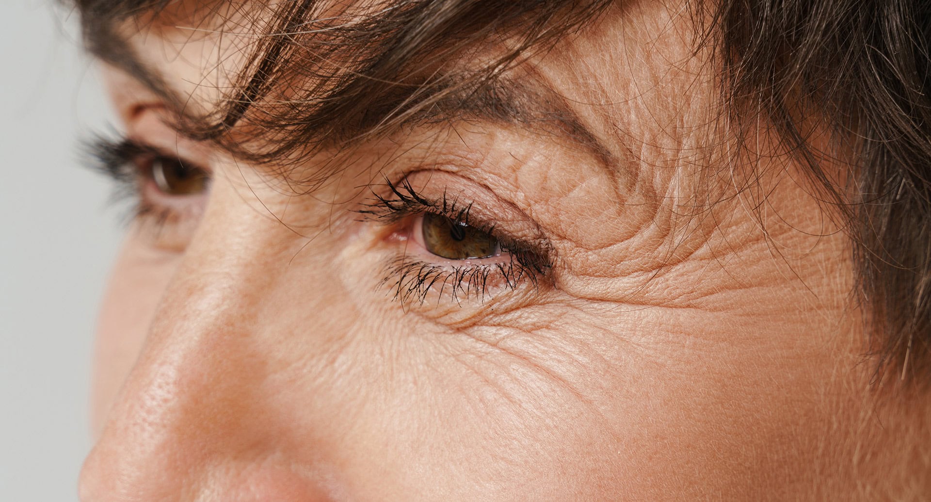 Treatment options for crow's feet in Morpeth
