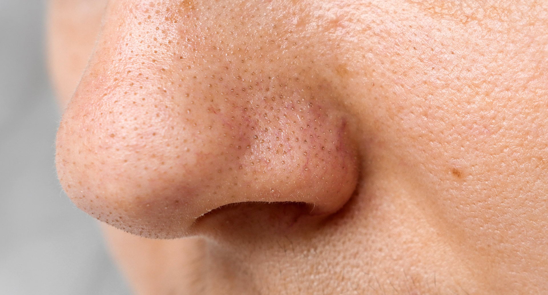 Close up of nose with enlarged pores