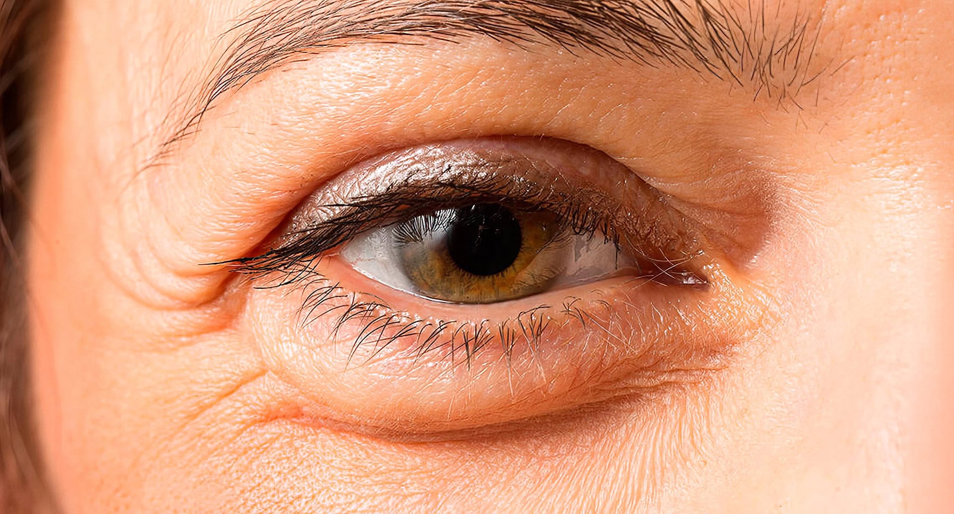 Puffy eyes treatment recommendations in Morpeth